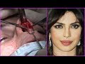 Top 12 Plastic Surgery Photos Of Popular Bollywood Actresses - BEFORE & AFTER